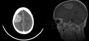 Imágenes de TC (izquierda) y RM (derecha) craneales preoperatorias, que demuestran la existencia de una lesión extraaxial compatible con el diagnóstico de meningioma.