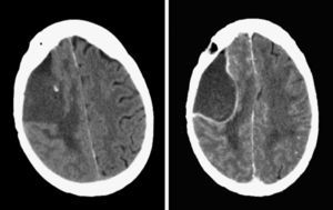 Imágenes de TC craneal con contraste por vía intravenosa a las 48 h de la cirugía (izquierda), donde simplemente se aprecian edema y cambios posquirúrgicos, y al mes de la cirugía (derecha), donde se evidencia captación en anillo, indicativa de absceso cerebral.