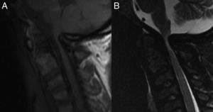 A) Secuencia T1. B) Secuencia STIR. Compresión de la unión bulbo-cervical a nivel del foramen magno, con daño del cordón medular a ese nivel compatible con mielomalacia. Los cuerpos vertebrales muestran morfología atípica (signo de la «cabeza de pescado»).