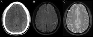TC (A) y RM de encéfalo, secuencias FLAIR (B) y GRE (C). HSA cortical aguda en el lóbulo parietal izquierdo. Adicionalmente, en la secuencia GRE se observa una microhemorragia crónica superficial en el lóbulo frontal derecho (flecha).