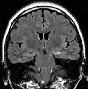 Paciente del grupo 2 con epilepsia temporal cuya IRM, en secuencia FLAIR coronal, mostraba una EH izquierda.