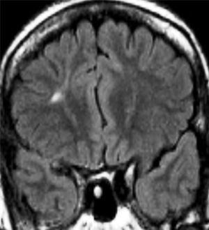 Paciente del grupo 2 con epilepsia extratemporal cuya IRM, en secuencia FLAIR coronal, mostraba una displasia cortical focal frontal derecha.