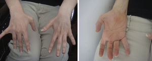 Imagen que muestra atrofia de músculos interóseos de ambas manos y de eminencia tenar derecha.