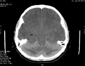 Corte axial de tomografía de cráneo simple donde se observa inversión de la diferenciación de la sustancia gris-blanca del cerebelo con hiperdensidad de la corteza cerebelosa, asociada a disminución de la atenuación del parénquima cerebral y pérdida de la diferenciación córtico-subcortical.