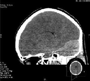 Corte sagital de tomografía de cráneo simple evidenciando la hiperdensidad del parénquima cerebeloso y la hipodensidad del parénquima cerebral por edema.