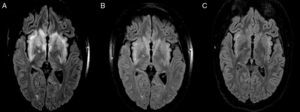 Imágenes de resonancia magnética (RM) de cerebro; cortes axiales ponderados en secuencia FLAIR. A) En el momento del ingreso. B) Posterior al tratamiento inmunosupresor. C) Control al mes del tratamiento inmunosupresor.