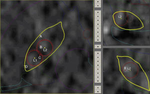 Representación espacial de lesiones (L1-L2) círculos rojos, en los 3 planos del espacio. A, B, C y D) Puntos de microrregistro. A y D) En amarillo bordes del NST. B y C) En rojo centro del NST.