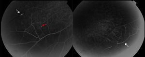Retinofluoresceinografía. Hiperfluorescencia vascular (flecha blanca), con zonas de falta de relleno vascular. Placa de Gass (flecha negra).