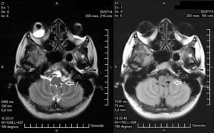 RMN: T2 axial (izquierda) y FLAIR axial (derecha). Arteria vertebral izquierda (T2) atrapada entre el cerebelo y la médula oblonga, en una hendidura a nivel de la fisura retro-olivar.