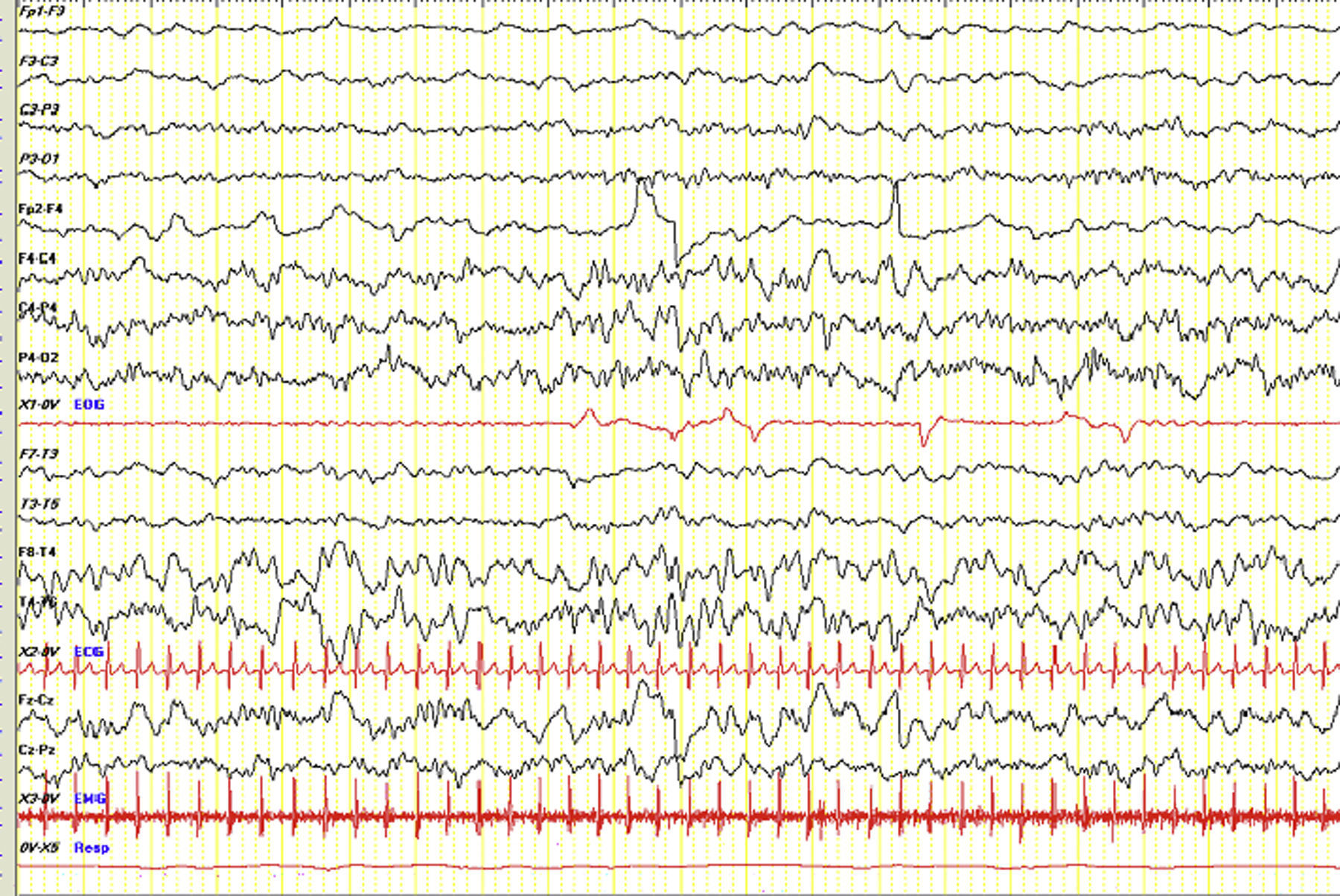 Eeg Rimer Hallazgos electroencefalográficos en un caso de aciduria D-2 ...
