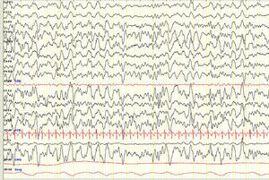 EEG evolutivo anual (fase N3 del sueño). Se aprecia una disminución de los hallazgos patológicos iniciales. Sens: 7μV/mm. Constante de tiempo: 0,3s; filtro de altas frecuencias: 30Hz.