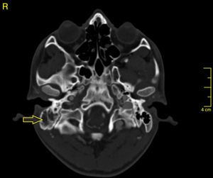 Corte axial de tomografía de cráneo con contraste en ventana ósea donde se observa ocupación de celdillas mastoideas derechas por material con densidad de tejido blando por mastoiditis.
