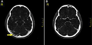 Cortes axiales de tomografía de cráneo con contraste en fase venosa (venografía por TC) donde se observa defecto de llenamiento parcial en el seno transverso derecho que se extiende hasta el seno sigmoideo (A), configurando el signo de «delta vacío» (B). No se evidencian alteraciones en el patrón de atenuación cerebral ni cerebeloso asociadas.