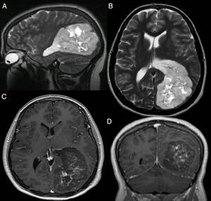 Resonancia magnética craneal prequirúrgica. Arriba (A y B) cortes sagital y axial respectivamente, en secuencia T2, que muestran una masa polilobulada con presencia de áreas quísticas y calcificaciones centrales, hiperintensa, adyacente al atrio del ventrículo lateral izquierdo, y que se extiende hacia el interior del parénquima cerebral invadiendo los lóbulos temporal, parietal y occipital ipsilateral. Abajo (C y D) cortes sagital y coronal, en secuencia T1 con gadolinio, donde se observa una tenue captación de contraste en la región central con morfología lineal que circunscribe las formaciones quísticas.