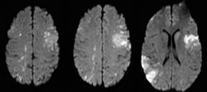 Imágenes axiales de cerebro en secuencias ponderadas de difusión, donde se aprecian múltiples lesiones isquémicas en distintos territorios vasculares.