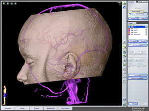 Planificación prequirúrgica que nos permite una orientación estereoscópica de la ubicación del tumor en relación con toda la cabeza.
