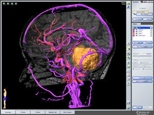 RM tridimensional en la que la neuronavegación ha reconstruido los principales senos venosos intracraneales, el polígono de Willis y la voluminosa masa tumoral en la fosa posterior.
