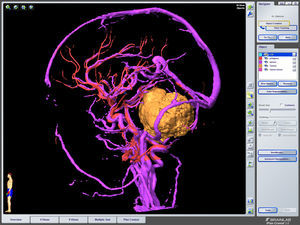 Igual imagen a la anterior en la que se ha sustraído la RM tridimensional.