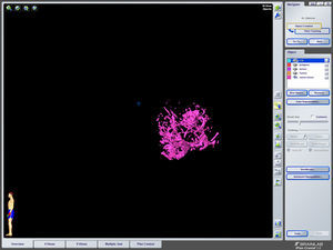 Lagos venosos intratumorales. Todas las figuras guardan relación espacial y de volumen entre sí.