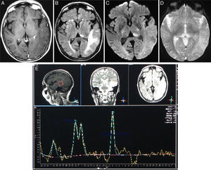 Resonancia magnética de cerebro. Cortes axiales en secuencias T1 con gadolinio (A), FLAIR (B), DWI (C), T2-GRE (D) y espectroscopía monovoxel con TE de 136ms (E). Se observa una extensa lesión subcortical temporooccipital izquierda con señal hipointensa en T1 e hiperintensa en FLAIR asociada a un aumento del refuerzo leptomeníngeo con el contraste y efecto de masa por colapso de los surcos corticales adyacentes. Además, se aprecian múltiples señales puntiformes hiperintensas en FLAIR en la sustancia blanca subcortical y lobular frontal bilateralmente y occipital derecha. En la secuencia de difusión solo existen áreas focales de restricción en el lóbulo occipital y el pulvinar a izquierda. No se observan microhemorragias en la secuencia T2*-GRE. En la curva espectroscópica se observa un descenso de la relación N-acetil-aspartato/creatina, sin cambios significativos en la relación colina/creatina. Es evidente un doblete negativo en 1,3ppm compatible con lactato.