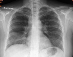 Radiografía de tórax: ensanchamiento del mediastino.