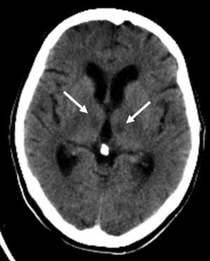 Tomografía computarizada de encéfalo sin contraste. Hipodensidad talámica bilateral (flechas).