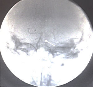 Angiografía digital. Arteria de Percheron (flecha).