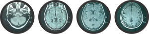RM encefálica, secuencia T2 FLAIR (6 de junio del 2012) (0,5 tesla). Sin lesiones específicas.