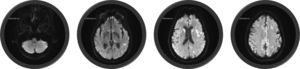 RM encefálica, secuencia difusión (2 de agosto del 2012) (3,0 tesla). Lesiones hiperintensas, especialmente en la sustancia gris, la corteza temporal, el girus angular izquierdo, los núcleos ventrales posteriores del tálamo, la cabeza de los núcleos caudados y la corteza cerebelosa.