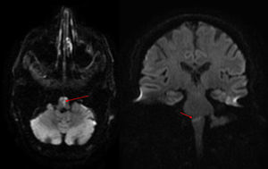 RM de cerebro (A, DWI axial y B, DWI coronal): imagen restrictiva en difusión a nivel del bulbo raquídeo y unión bulbo-protuberancial predominantemente central con ligera lateralización hacia la izquierda.