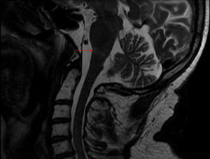 RM columna cervical (T2): imagen hipertensa en T2 que abarca el eje anteroposterior de la unión bulbo-protuberancial.