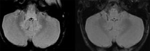 Axial FLAIR hiperintensidad de señal en los núcleos dentados del cerebelo y en bulbo, que disminuye en el control (imagen de la derecha).