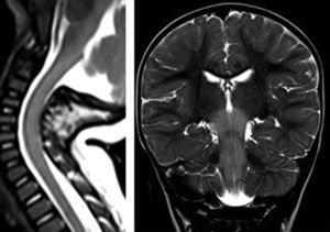Axial T2, a la izquierda corte axial a nivel del mesencéfalo, hiperintensidad de señal del tronco, con normalización en el control; a la derecha, corte axial a nivel del bulbo y cerebelo, hiperintensidad de señal en bulbo y núcleos dentados del cerebelo, con normalización en el control.