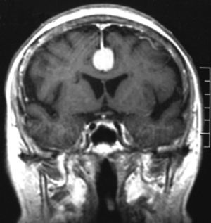 Coronal T1 con gadolinio, meningioma incidental de la hoz cerebral en una paciente de 76 años.