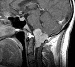 RM sagital T1 con gadolinio: meningioma de la charnela cráneo-raquídea con realce dural.