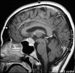RM sagital T1 con gadolinio: meningioma del tubérculo selar con extensión supraselar.