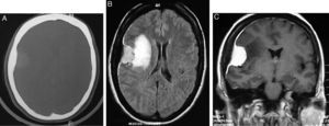 A) TC con ventana ósea: lesión nodular con realce y engrosamiento óseo adyacente. B) RM axial Flair: lesión extraaxial hiperintensa con signos de edema vasogénico, efecto de masa sobre el ventrículo, engrosamiento dural e hiperostosis. C) RM coronal T1 con gadolinio: realce intenso y homogéneo con cola dural. Dx: meningioma e hiperostosis con afección fronto-insular.