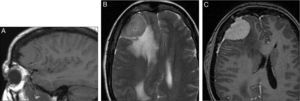 A) RM sagital T1: lesión frontal extraaxial isointensa. B) Axial T2: misma lesión discretamente hiperintensa con signos de edema vasogénico adyacente, efecto de masa y desviación de la línea media. C) Axial T1 con gadolinio: realce intenso y homogéneo y refuerzo dural (signo de la cola dural). Dx: meningioma frontal derecho.