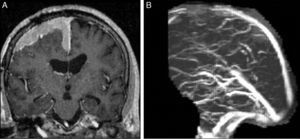 A) RM Coronal T1 con gadolinio: lesión extraaxial con crecimiento en placa y realce intenso y homogéneo en la convexidad y la hoz cerebral. B) Angio-RM en tiempo venoso: pérdida de señal en el sector anterior del seno longitudinal superior. Dx: meningioma de la convexidad con compromiso del seno venoso.