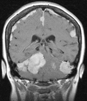 RM coronal T1 con gadolinio: múltiples lesiones extraaxiales, varias confluentes y con crecimiento en placa con intenso realce. Dx: meningiomatosis difusa.