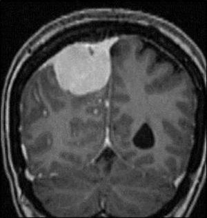 RM coronal T1 con gadolinio: masa parietal extraaxial con realce intenso y homogéneo que abarca el seno longitudinal superior y engrosamiento dural que se afina de proximal a distal (signo de la cola dural). Dx: meningioma parietal con invasión del seno venoso.