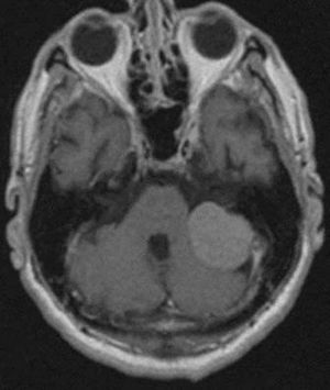 Axial T1 con gadolinio: meningioma del ángulo pontocerebeloso izquierdo con efecto de masa sobre el pedúnculo cerebeloso medio y el hemisferio cerebeloso.
