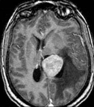 RM axial T1 con gadolinio: masa que ensancha el ventrículo lateral izquierdo, desvía la línea media y genera edema vasogénico. Dx: meningioma intraventricular.