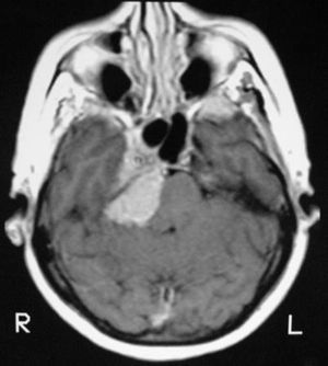 RM axial T1 con gadolinio: meningioma petroclival con extensión paraselar derecha en un paciente con neuralgia del trigémino.