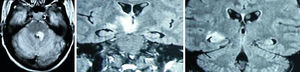 Caso 2: RMN encefálica: lesión en tronco encefálico, mesencéfalo, tálamo e hipocampo derecho.