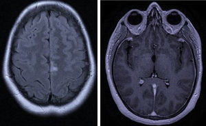 Caso 2: RMN encefálica: lesión frontal izquierda. Refuerzo meníngeo.
