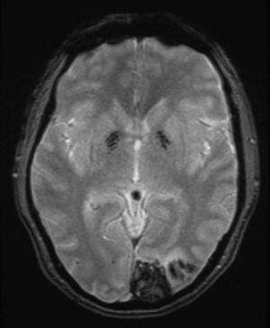Secuencia eco de gradiente T2, se observa hemorragia intracerebral occipital izquierda y microsangrados cerebrales múltiples en ganglios de la base.