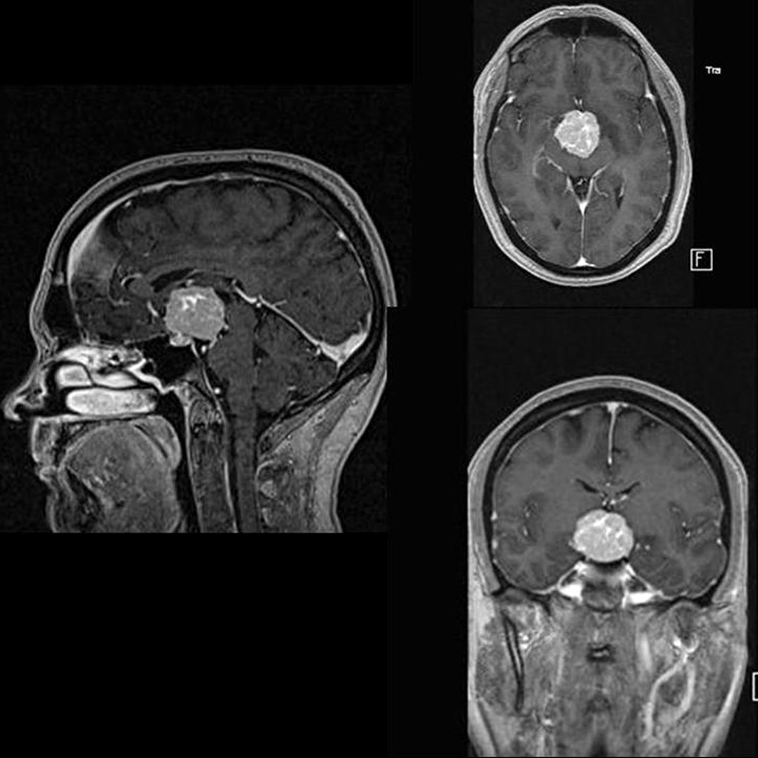 Pituicitoma Hipofisario Neurolog a Argentina pituicitoma-hipofisario-neurolog-a-argentina