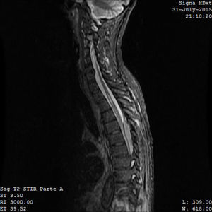 Resonancia magnética (sagital STIR): lesión intracanalicular que comprime e infiltra la médula espinal con afinamiento de la misma.