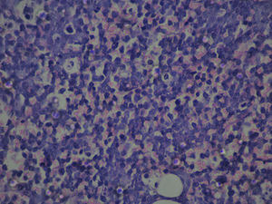 Hematoxilina/eosina 40×: proliferación de células atípicas de estirpe linfoide, con escaso citoplasma, núcleos irregulares de mediano tamaño y varios nucléolos.